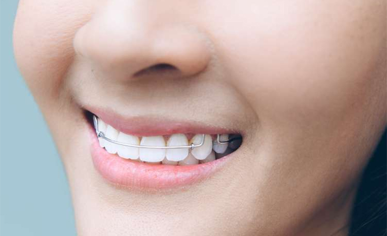 リテイナーとは何ですか？