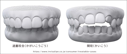 口腔内の状況例