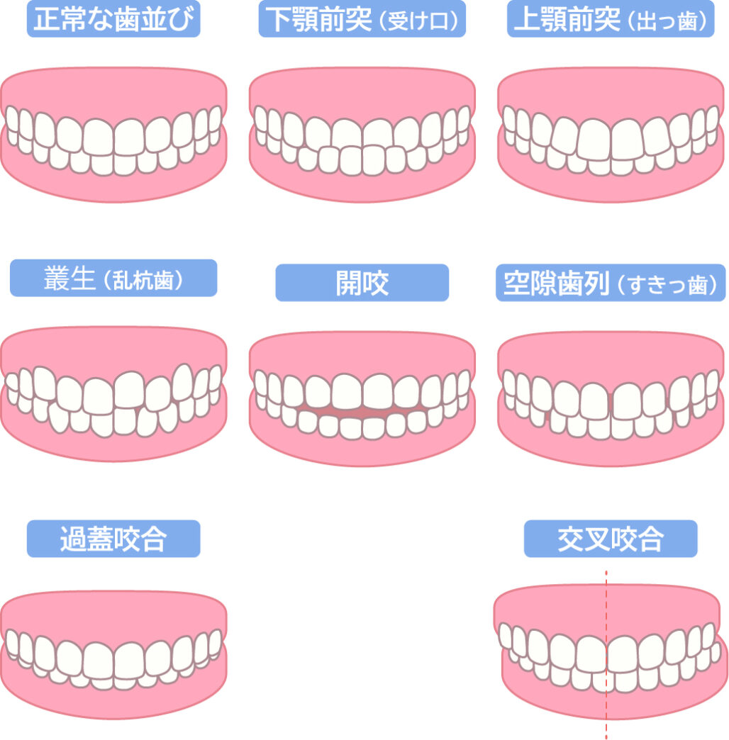 歯並びの種類
