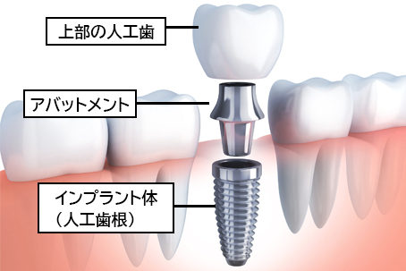 インプラントの構造