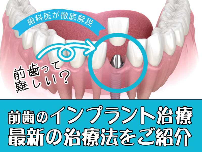 前歯のインプラント治療は難しい？ 最新の治療法をご紹介します