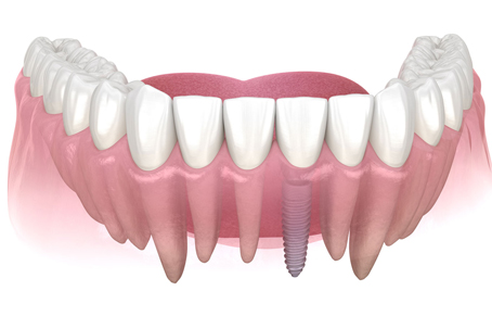 前歯のインプラント