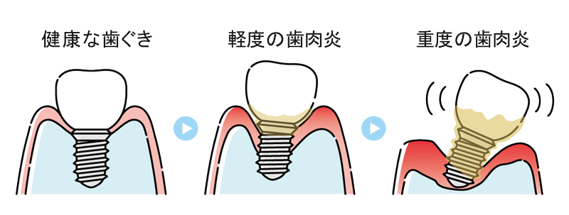 インプラント歯周炎