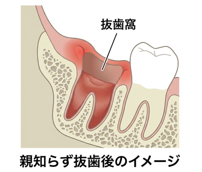 親知らず抜歯後の抜歯窩イメージ