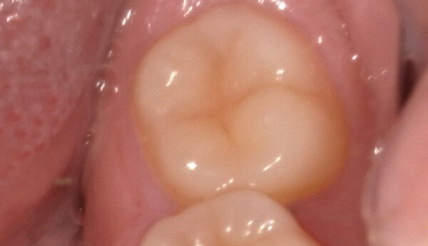Before