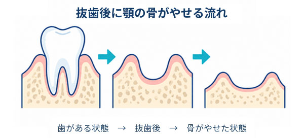 歯を失った後の顎の骨吸収など、骨造成が必要になる主な原因を示す図