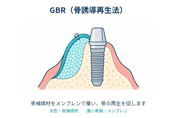 GBR(骨誘導再生法)で骨補填材とメンブレンを用いて骨の再生を促す仕組みを示す図