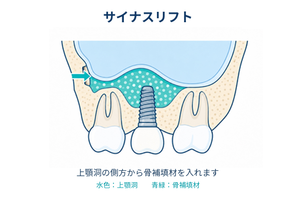 側方から上顎洞の粘膜を持ち上げて骨補填材を入れるサイナスリフトのイメージ