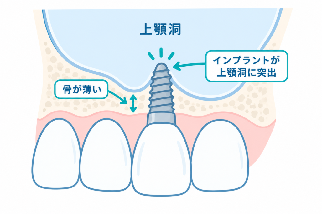 前歯部分は顎の骨が薄く、インプラントの埋入位置や角度に高い精度が求められることを示す断面図