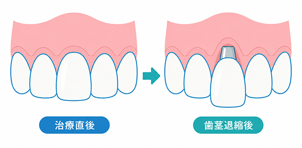 治療直後と歯茎退縮後の比較。歯茎が下がるとアバットメントが見えてしまうことを示すイラスト