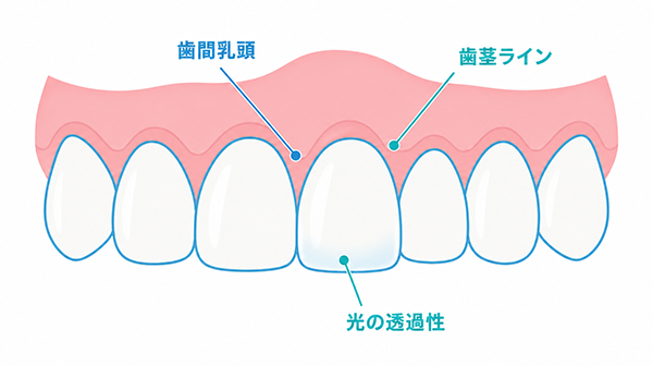 歯間乳頭・歯茎ライン・光の透過性など、前歯の審美性で重視されるポイントを示す図
