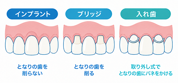 インプラントは隣の歯を削らない、ブリッジは削る、入れ歯は隣の歯にバネをかけることを比較したイラスト
