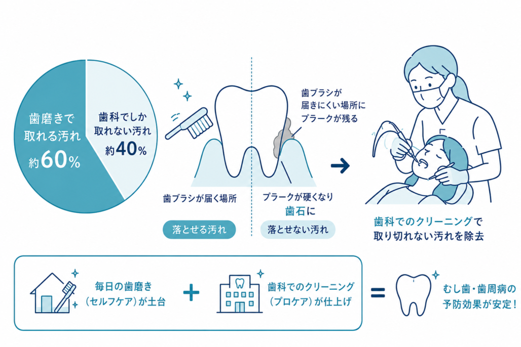 歯磨きで落とせる汚れは約6割、残り4割は歯科でしか除去できないことを示す図。セルフケアとプロケアの組み合わせで予防効果が安定することも解説