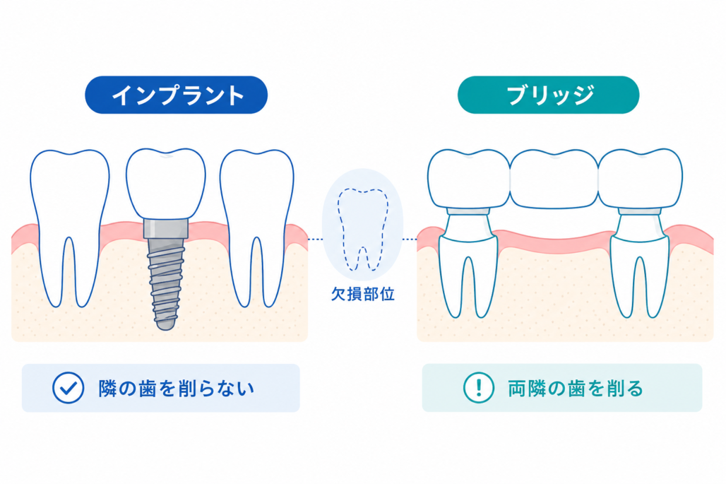 インプラントとブリッジの違いのイラスト