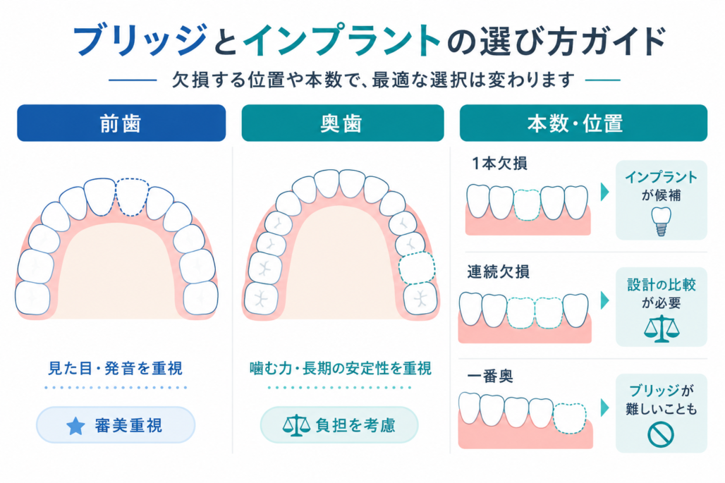 インプラントとブリッジの選び方の図