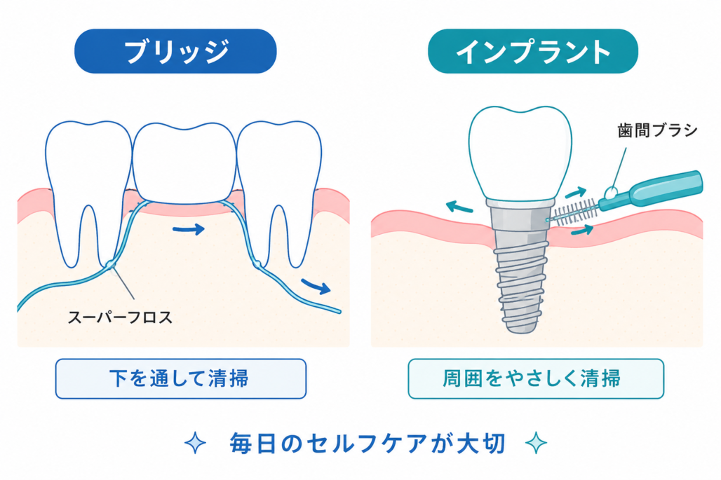インプラントとブリッジのケアの違いの図